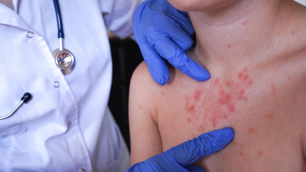Minnesota's 80 measles cases this year are the most since 1990, health officials say — Brooklyn Park Health news