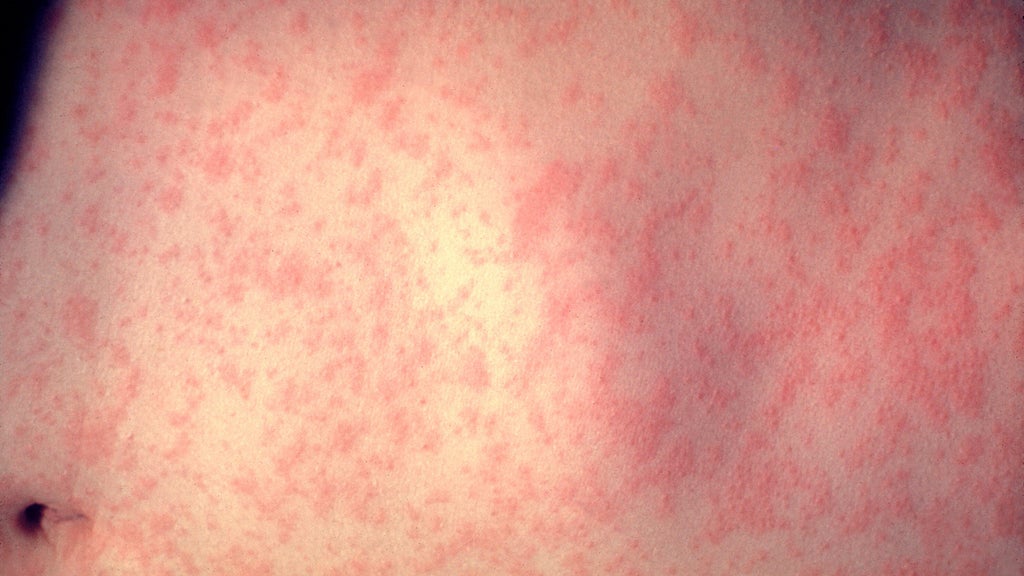 25 cases of measles identified in central, southeastern Minnesota, MDH says — WCCO / CBS Minnesota, Brooklyn Park Health news